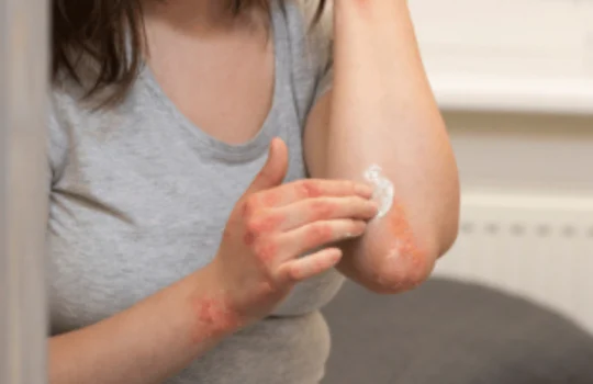 Medicamentos para tratamento da psoríase