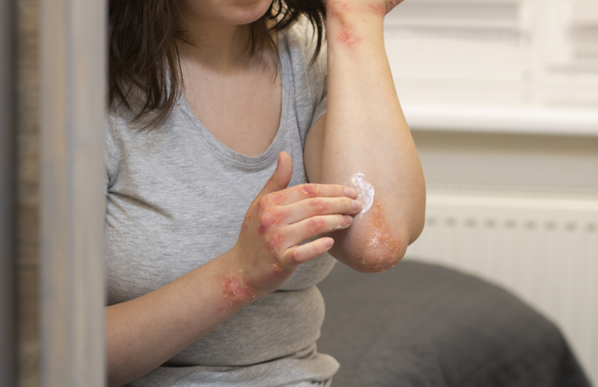 tratamento-de-paciente-que-sofre-de-psoriase-pharmed