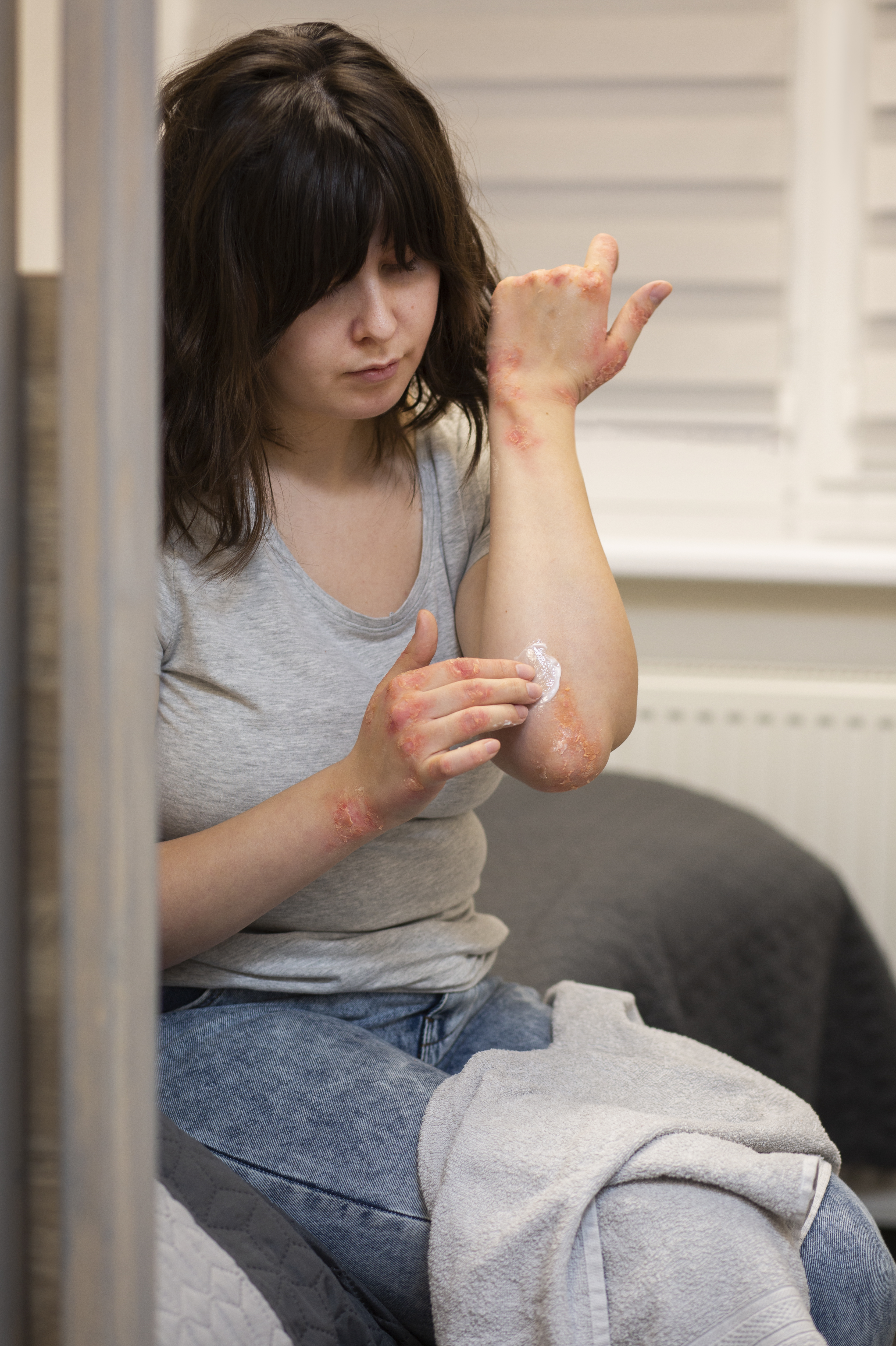 tratamento-de-paciente-que-sofre-de-psoriase-pharmed