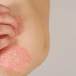 Imunossupressores na Psoríase