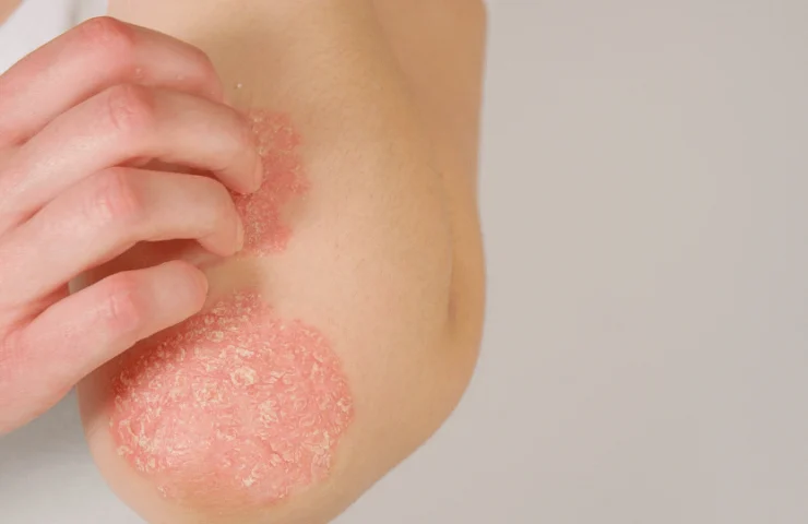 Imunossupressores na Psoríase